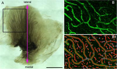 Investigations of the Microvasculature of the Human Macula Utricle in Meniere’s Disease